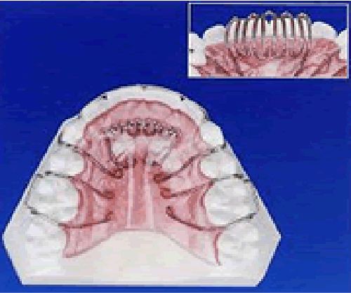 舌癖改善装置（タングクリブ）の画像1