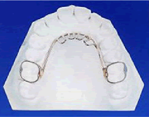舌癖改善装置（タングクリブ）の画像2