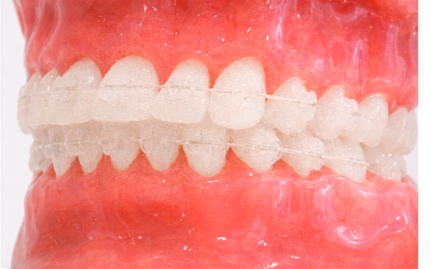 表側矯正歯科装置